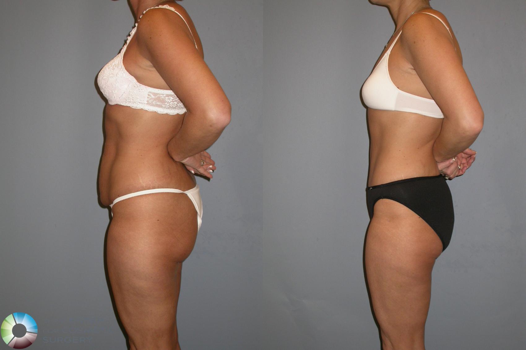 Before & After Tummy Tuck Case 343 View #3 View in Golden, CO