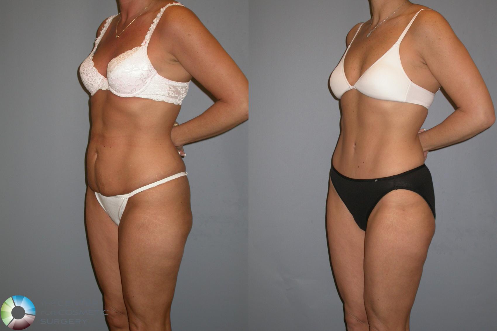 Before & After Tummy Tuck Case 343 View #4 View in Golden, CO