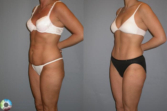 Before & After Tummy Tuck Case 343 View #4 in Denver, CO