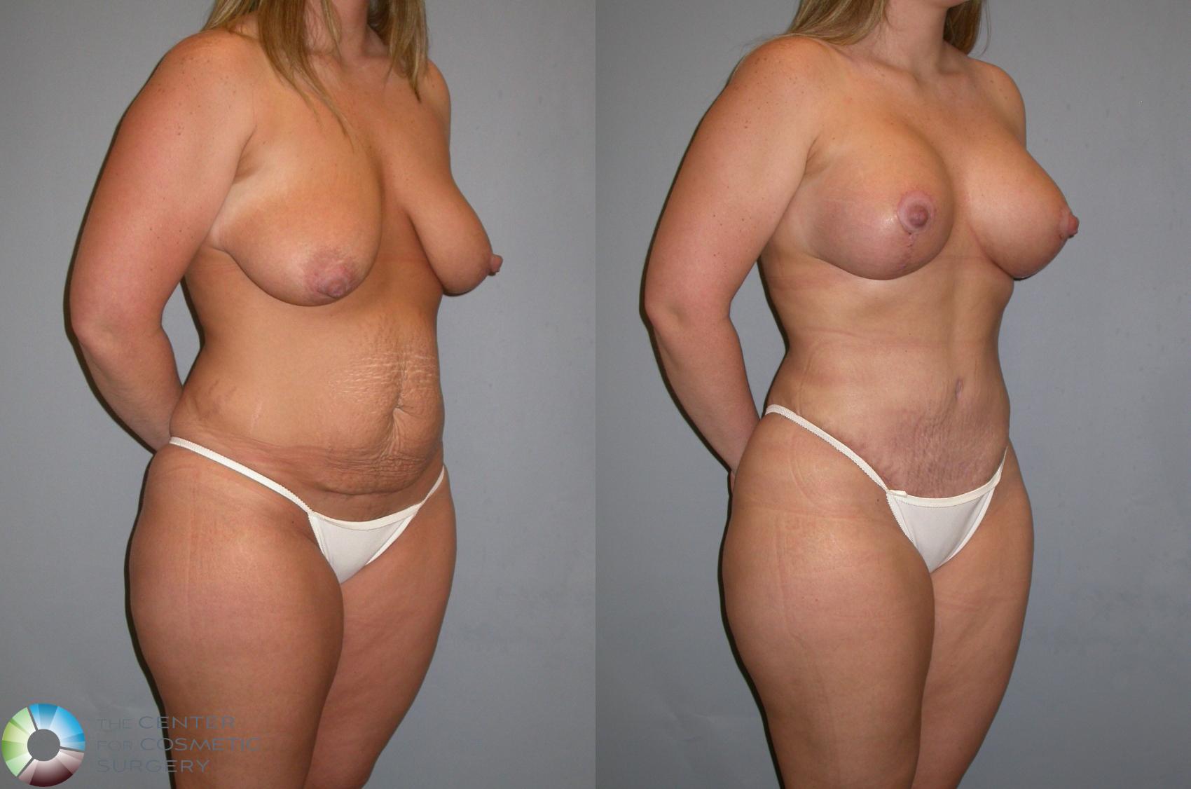 Before & After Tummy Tuck Case 348 View #1 in Denver and Colorado Springs, CO