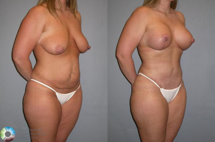 Before & After Tummy Tuck Case 348 View #1 View in Golden, CO
