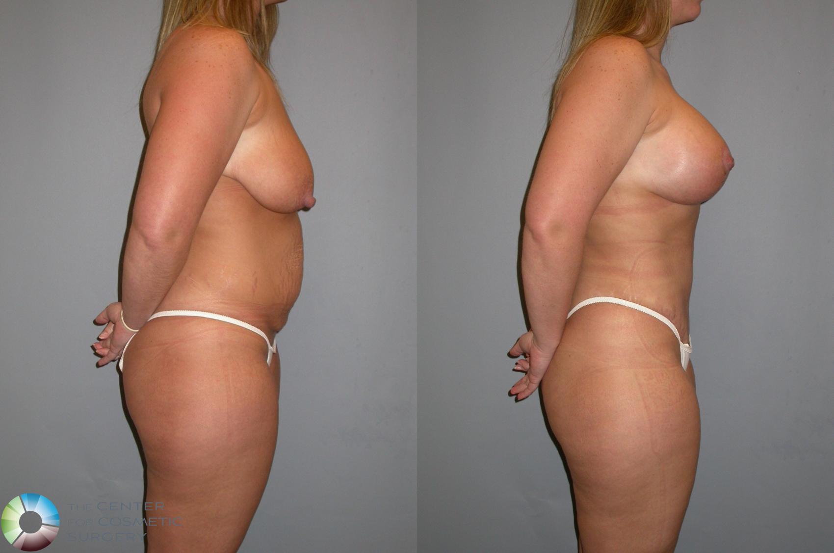Before & After Tummy Tuck Case 348 View #2 in Denver and Colorado Springs, CO