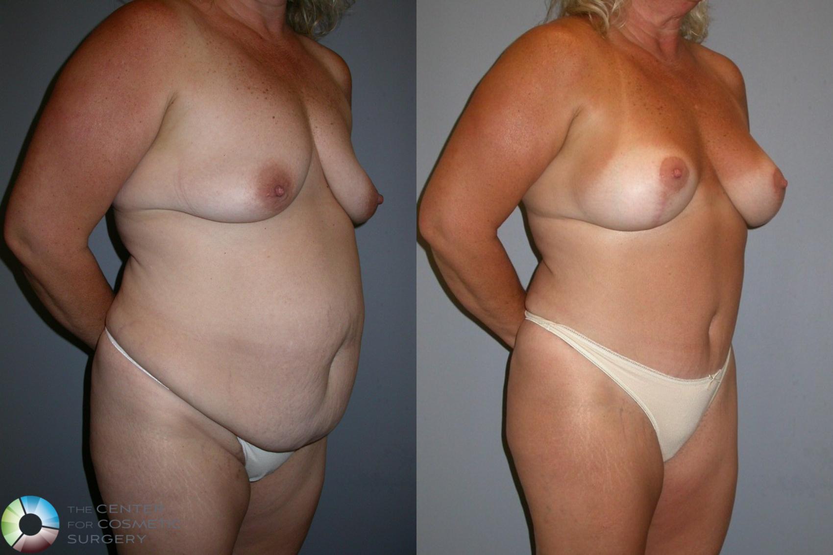 Before & After Tummy Tuck Case 35 View #1 in Denver and Colorado Springs, CO