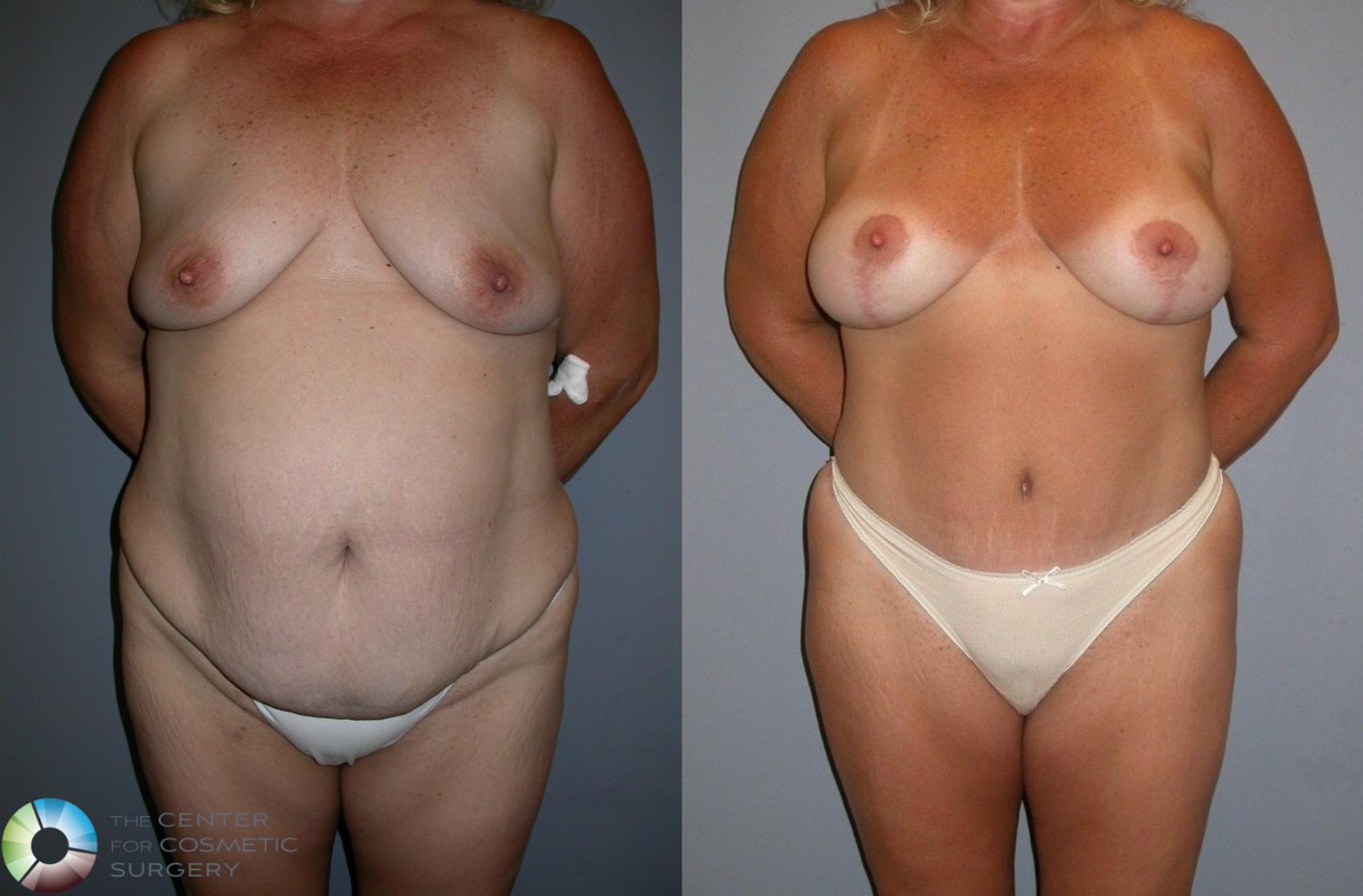 Before & After Tummy Tuck Case 35 View #2 in Denver and Colorado Springs, CO