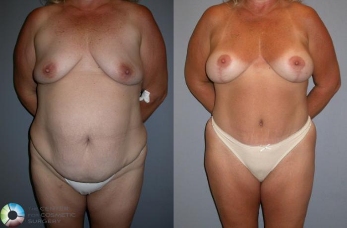 Before & After Tummy Tuck Case 35 View #2 in Denver and Colorado Springs, CO