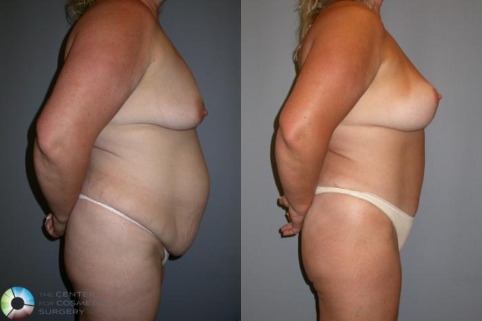 Before & After Tummy Tuck Case 35 View #3 in Denver and Colorado Springs, CO
