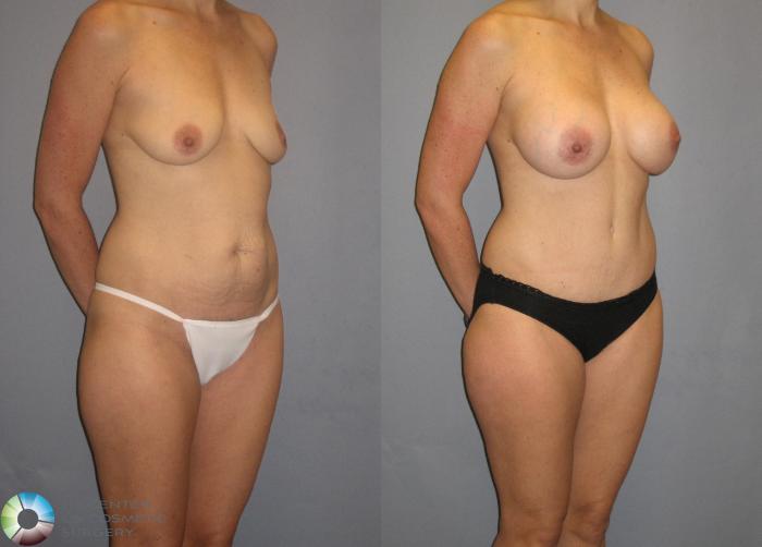Before & After Tummy Tuck Case 350 View #1 in Denver and Colorado Springs, CO