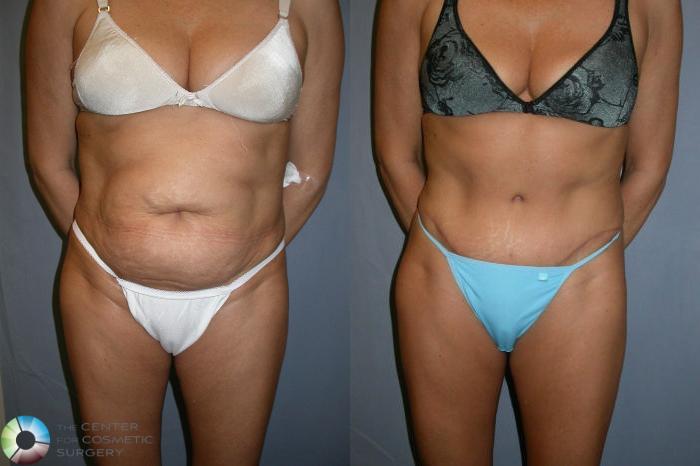 Before & After Tummy Tuck Case 36 View #1 in Denver and Colorado Springs, CO