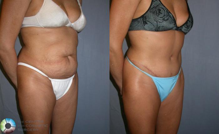 Before & After Tummy Tuck Case 36 View #2 in Denver and Colorado Springs, CO