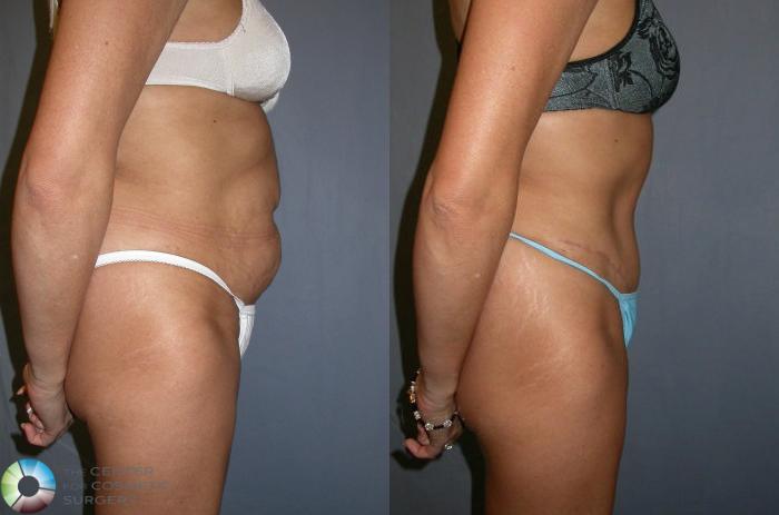 Before & After Tummy Tuck Case 36 View #3 in Denver and Colorado Springs, CO