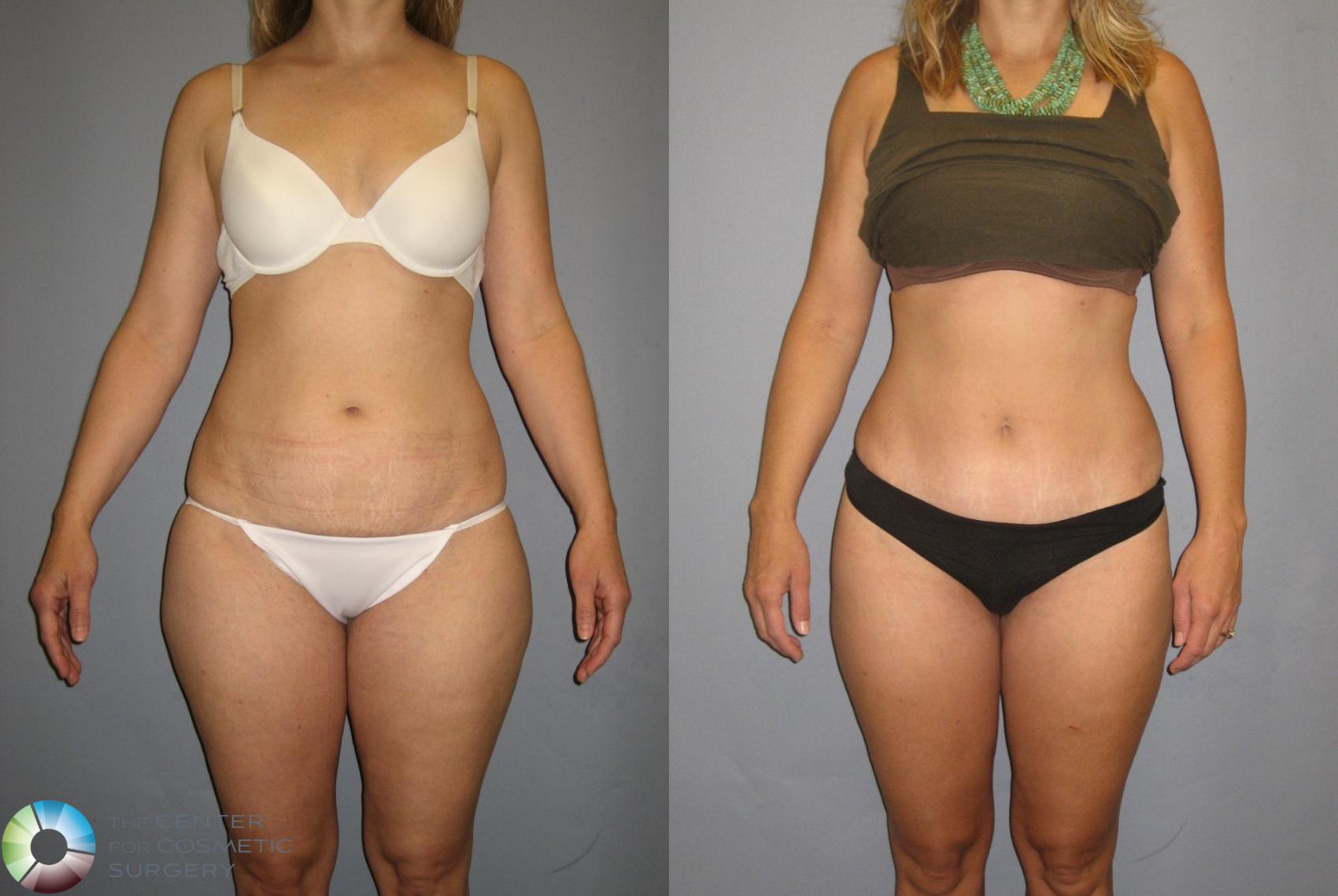 Before & After Tummy Tuck Case 381 View #1 in Denver and Colorado Springs, CO