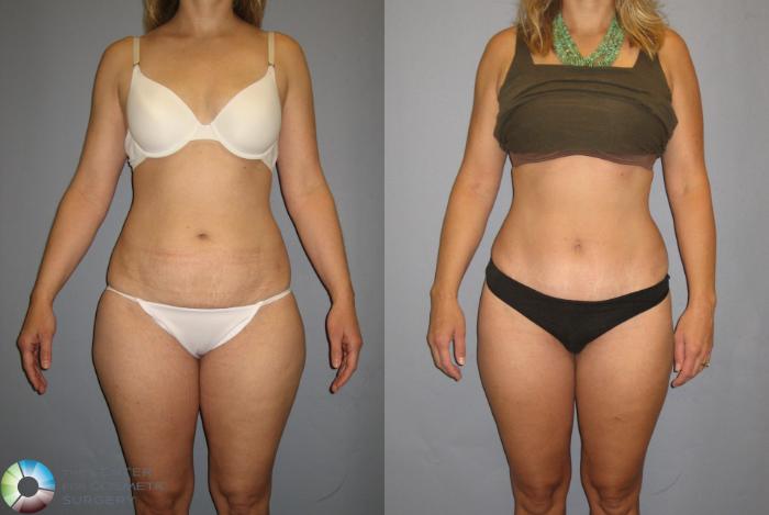 Before & After Tummy Tuck Case 381 View #1 in Denver, CO