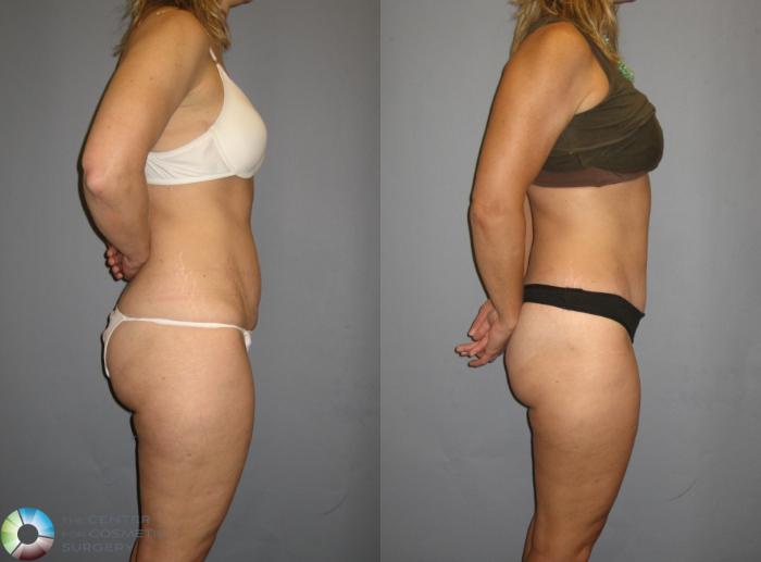 Before & After Tummy Tuck Case 381 View #2 in Denver, CO