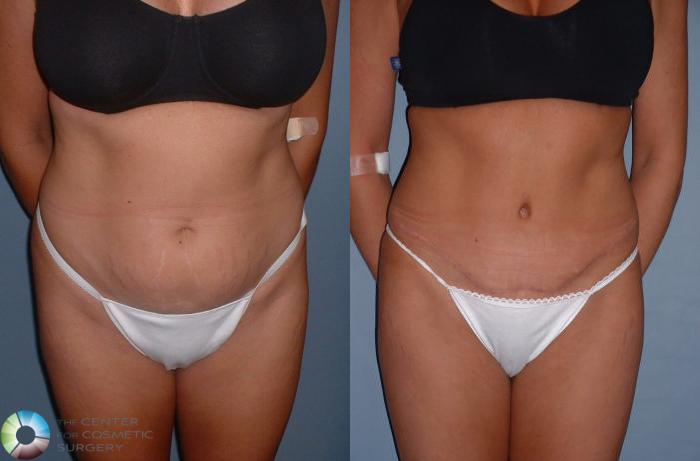 Before & After Tummy Tuck Case 40 View #1 in Denver and Colorado Springs, CO