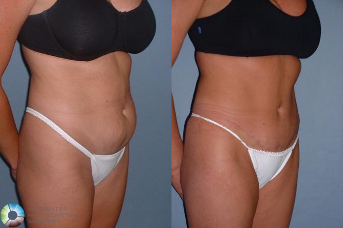 Before & After Tummy Tuck Case 40 View #2 in Denver and Colorado Springs, CO