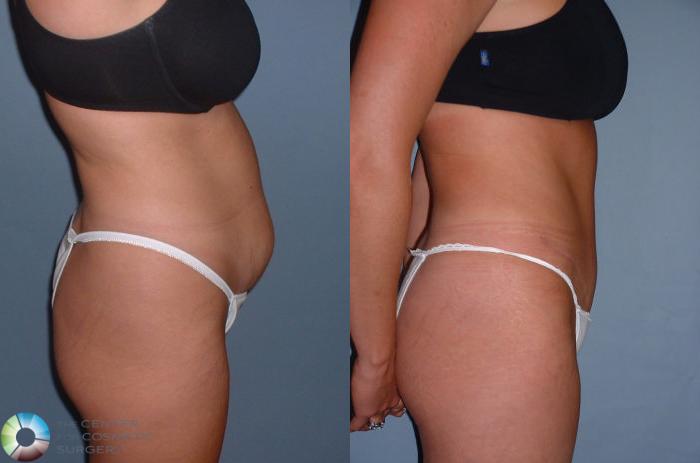 Before & After Tummy Tuck Case 40 View #3 in Denver and Colorado Springs, CO