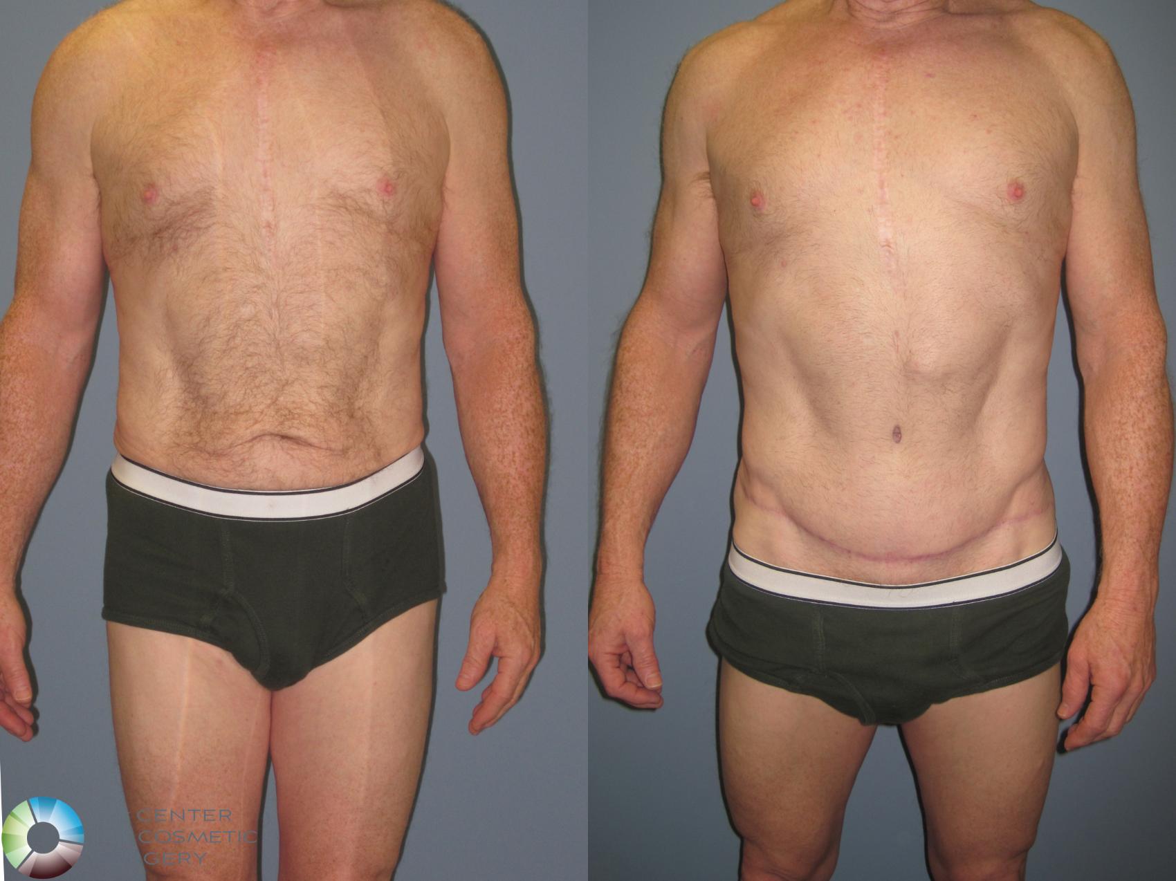 Tummy Tuck (Abdominoplasty) for Denver & Colorado Springs