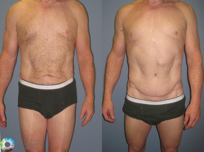 Before & After Tummy Tuck Case 426 View #1 View in Golden, CO