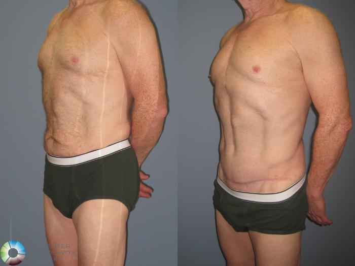 Before & After Tummy Tuck Case 426 View #2 View in Golden, CO