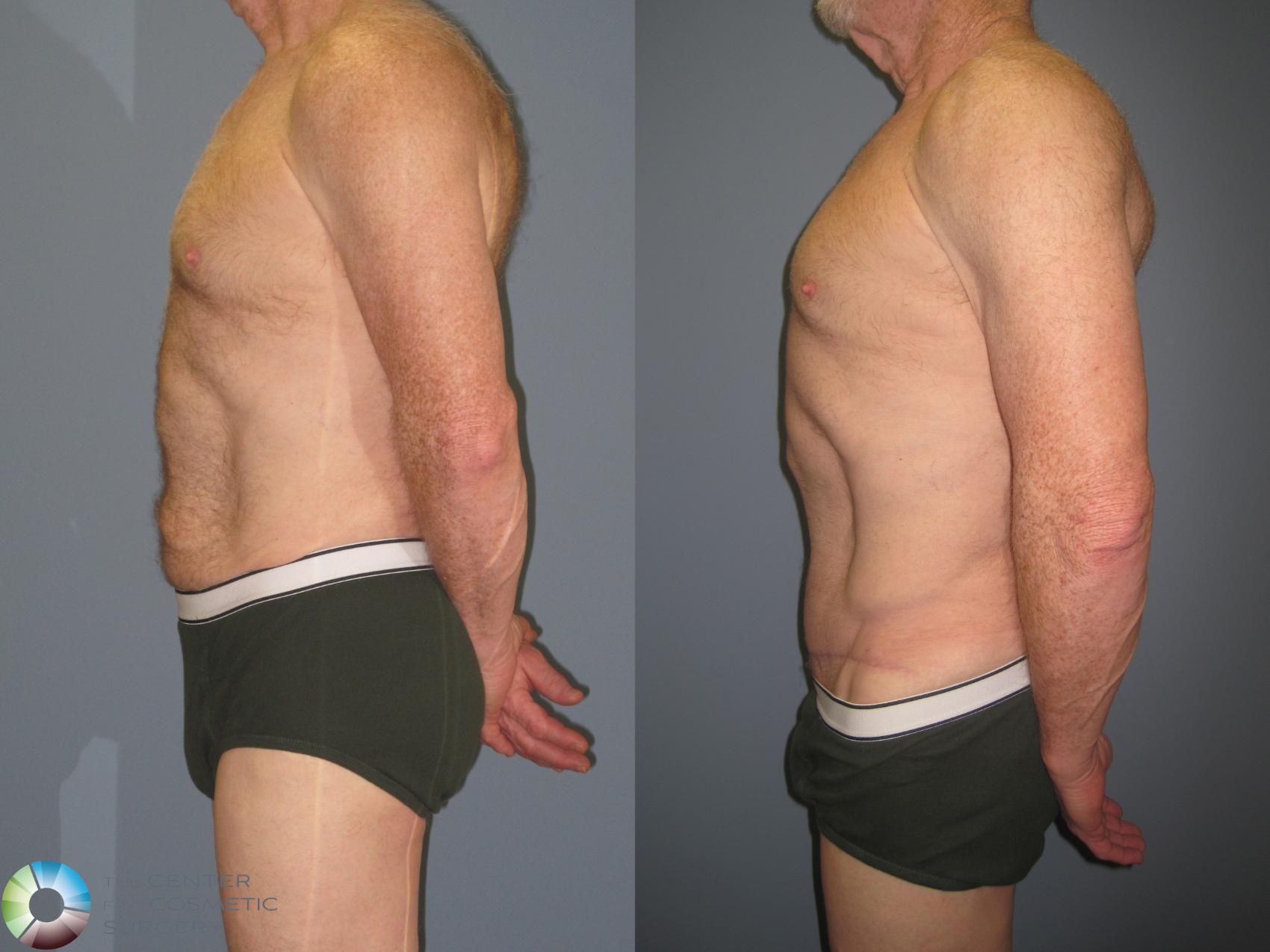Before & After Tummy Tuck Case 426 View #3 in Denver and Colorado Springs, CO