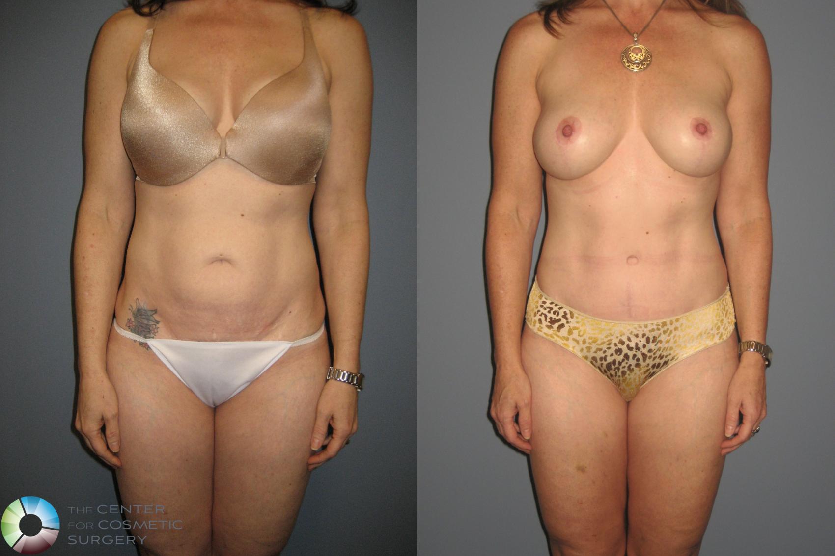 Before & After Tummy Tuck Case 435 View #1 in Denver and Colorado Springs, CO