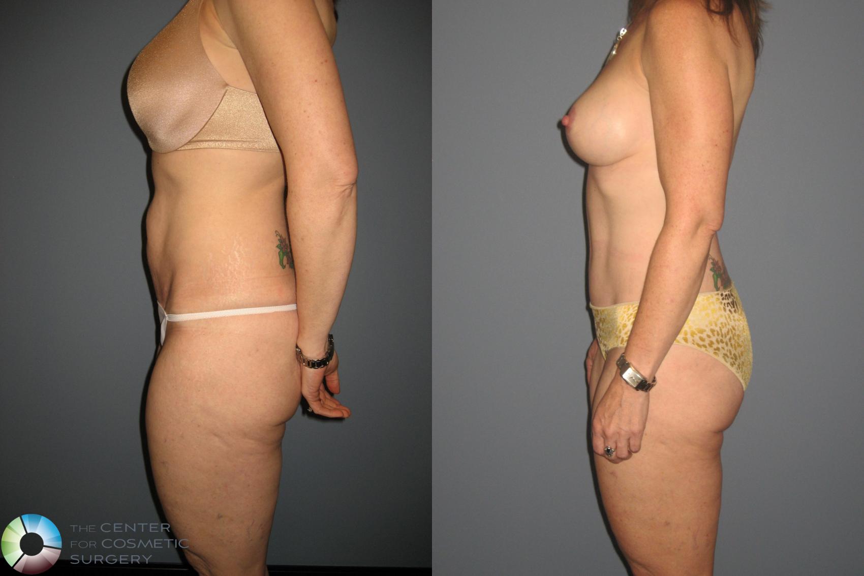 Before & After Tummy Tuck Case 435 View #2 in Denver and Colorado Springs, CO