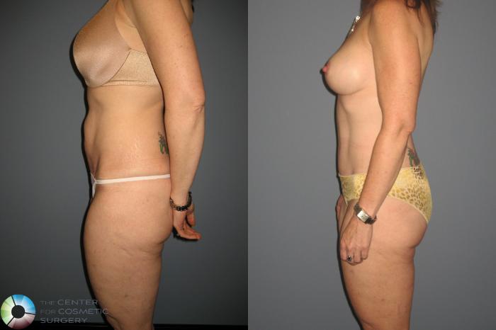 Before & After Tummy Tuck Case 435 View #2 in Denver and Colorado Springs, CO
