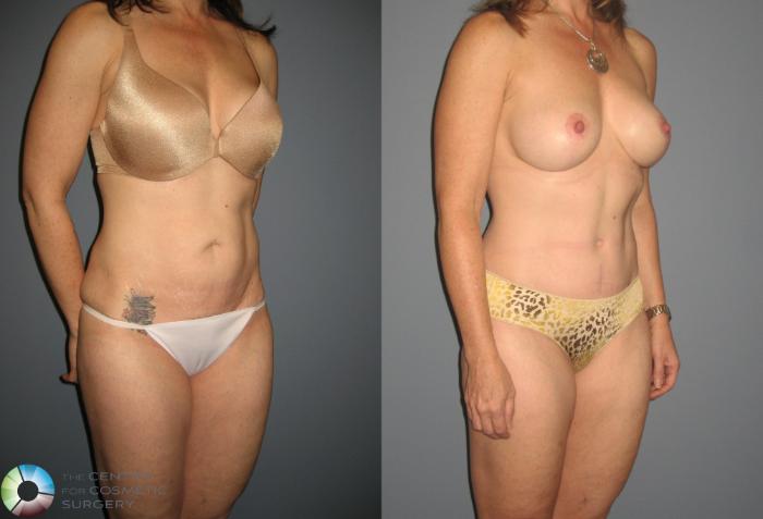 Before & After Tummy Tuck Case 435 View #3 in Denver and Colorado Springs, CO