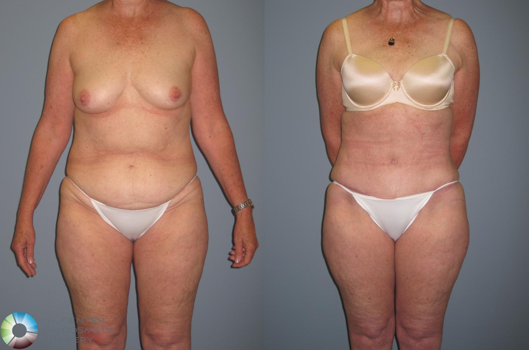 Before & After Tummy Tuck Case 436 View #1 in Denver and Colorado Springs, CO