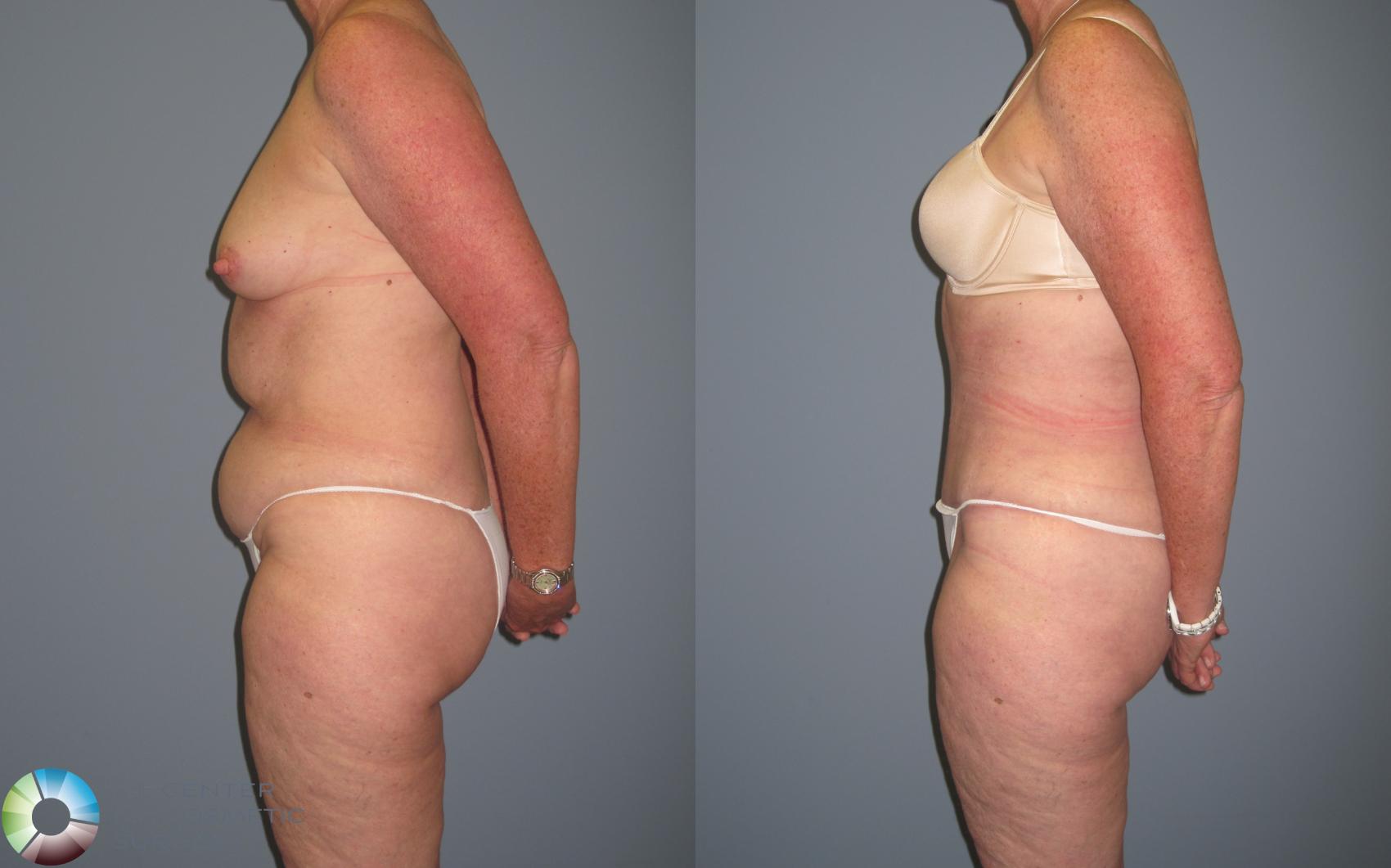Before & After Tummy Tuck Case 436 View #2 View in Golden, CO