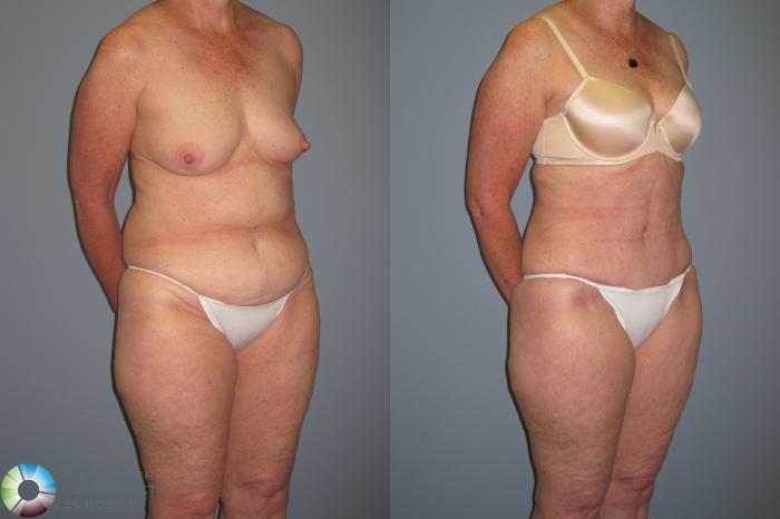 Before & After Tummy Tuck Case 436 View #3 View in Golden, CO