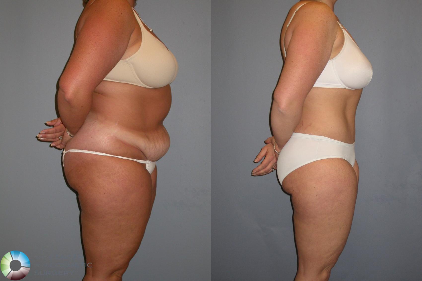 Before & After Tummy Tuck Case 439 View #1 in Denver and Colorado Springs, CO