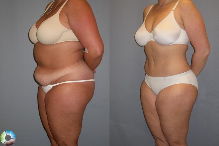 Before & After Tummy Tuck Case 439 View #2 View in Golden, CO