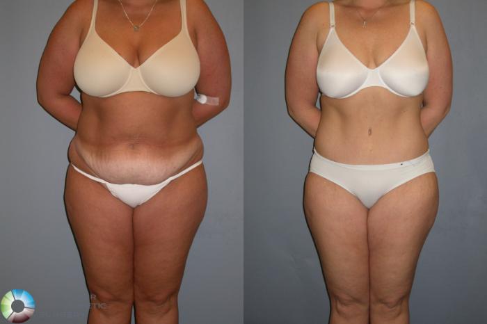 Before & After Tummy Tuck Case 439 View #3 View in Golden, CO