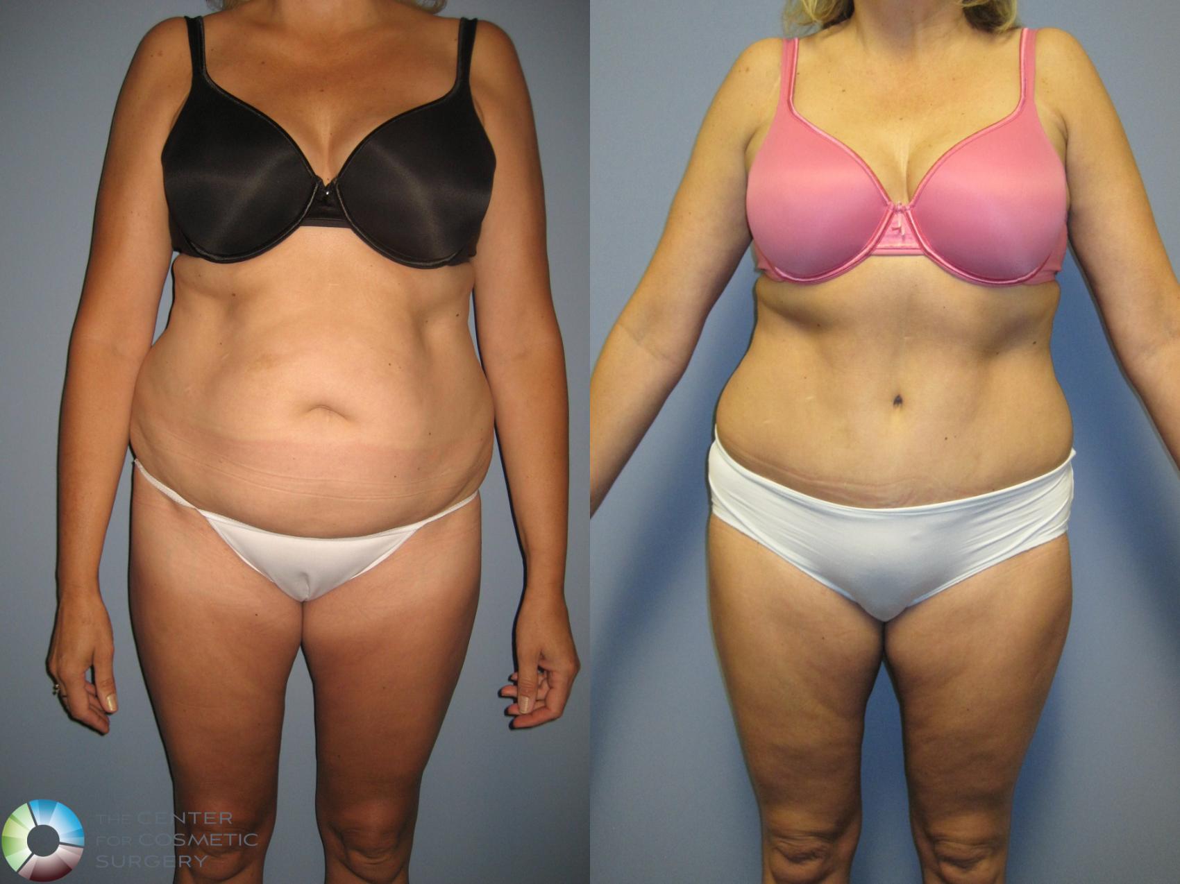 Before & After Tummy Tuck Case 444 View #1 in Denver and Colorado Springs, CO