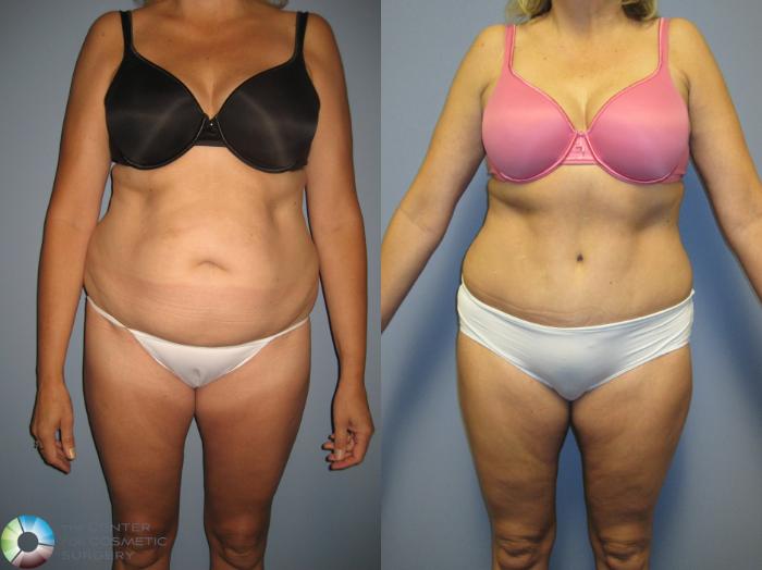 Before & After Liposuction Case 444 View #1 in Denver and Colorado Springs, CO