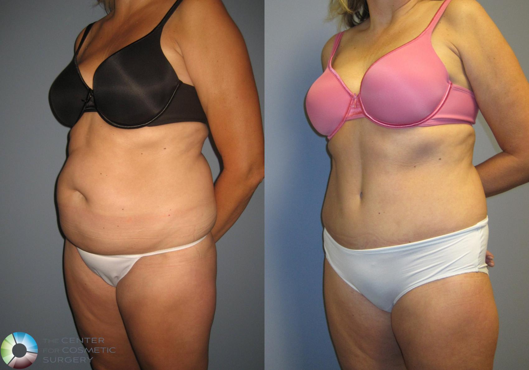 Before & After Tummy Tuck Case 444 View #2 View in Golden, CO