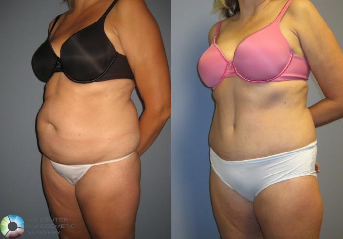 Before & After Liposuction Case 444 View #2 in Denver and Colorado Springs, CO