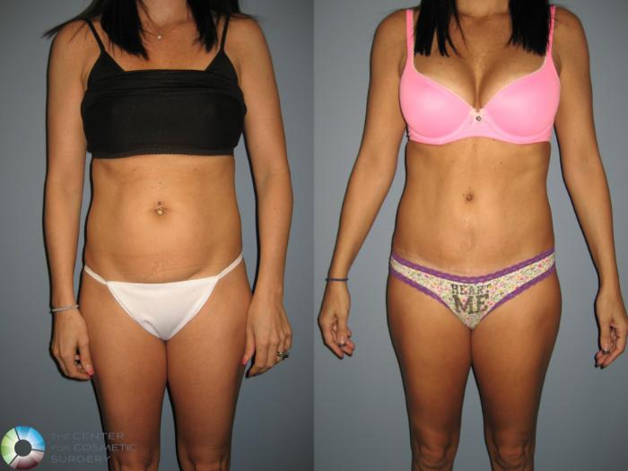 Before & After Tummy Tuck Case 447 View #1 View in Golden, CO