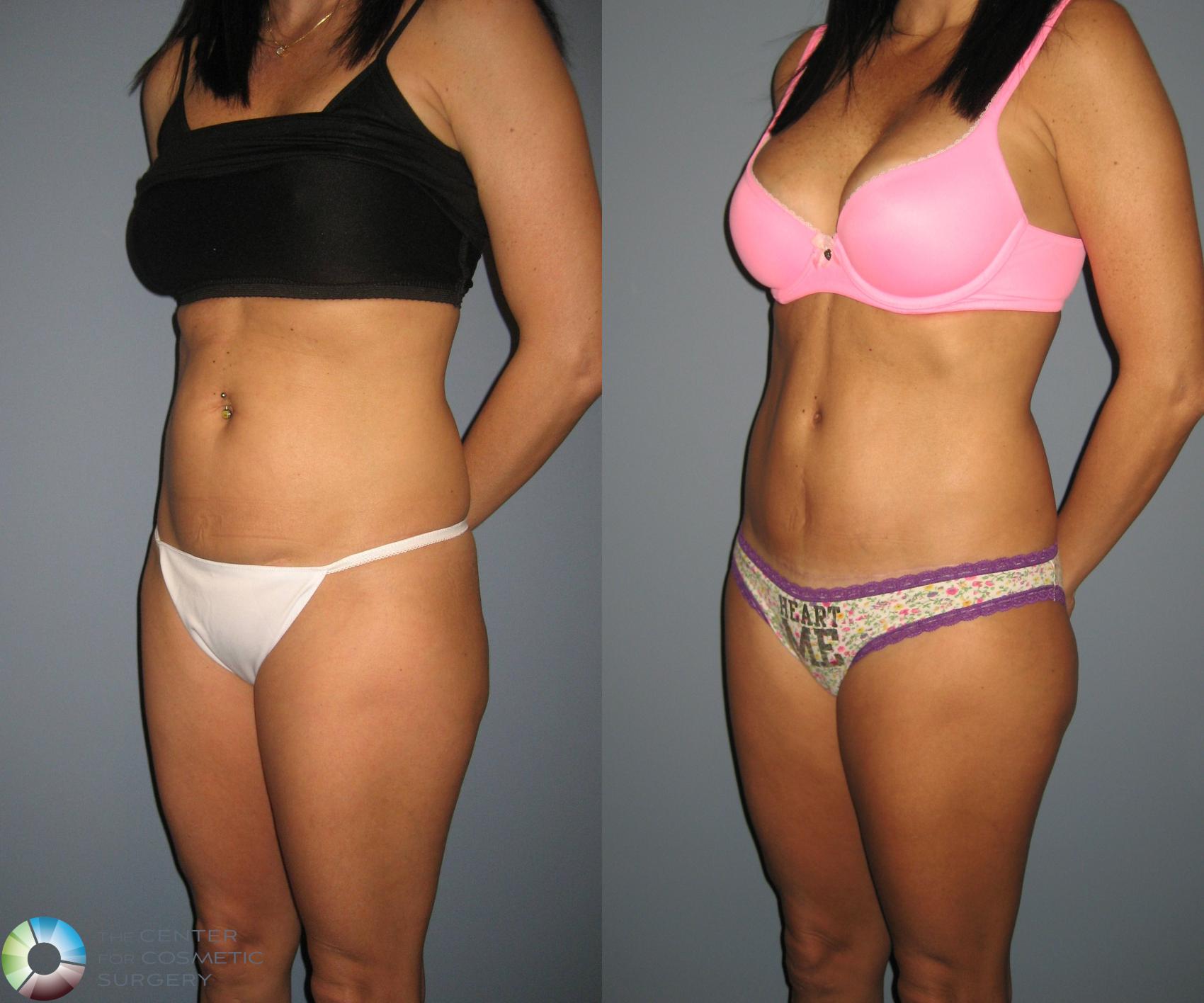 Before & After Tummy Tuck Case 447 View #2 in Denver and Colorado Springs, CO