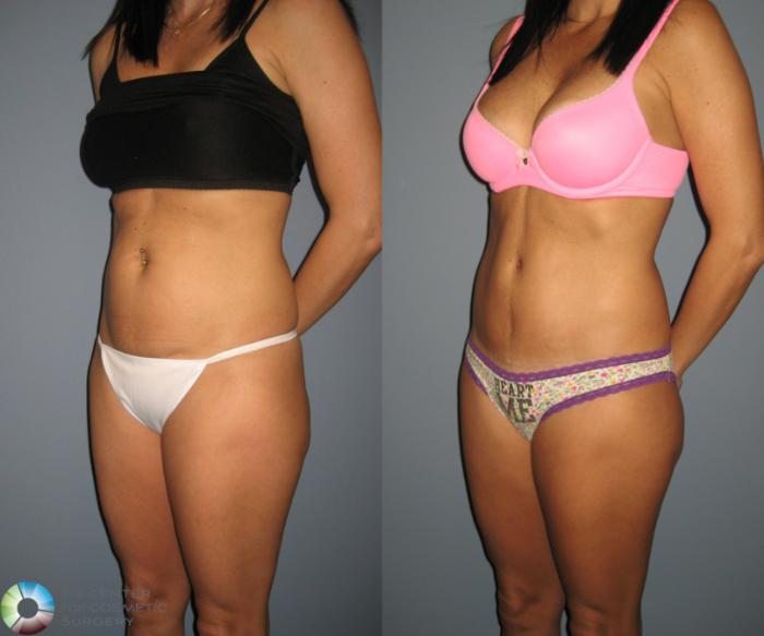 Before & After Tummy Tuck Case 447 View #2 View in Golden, CO