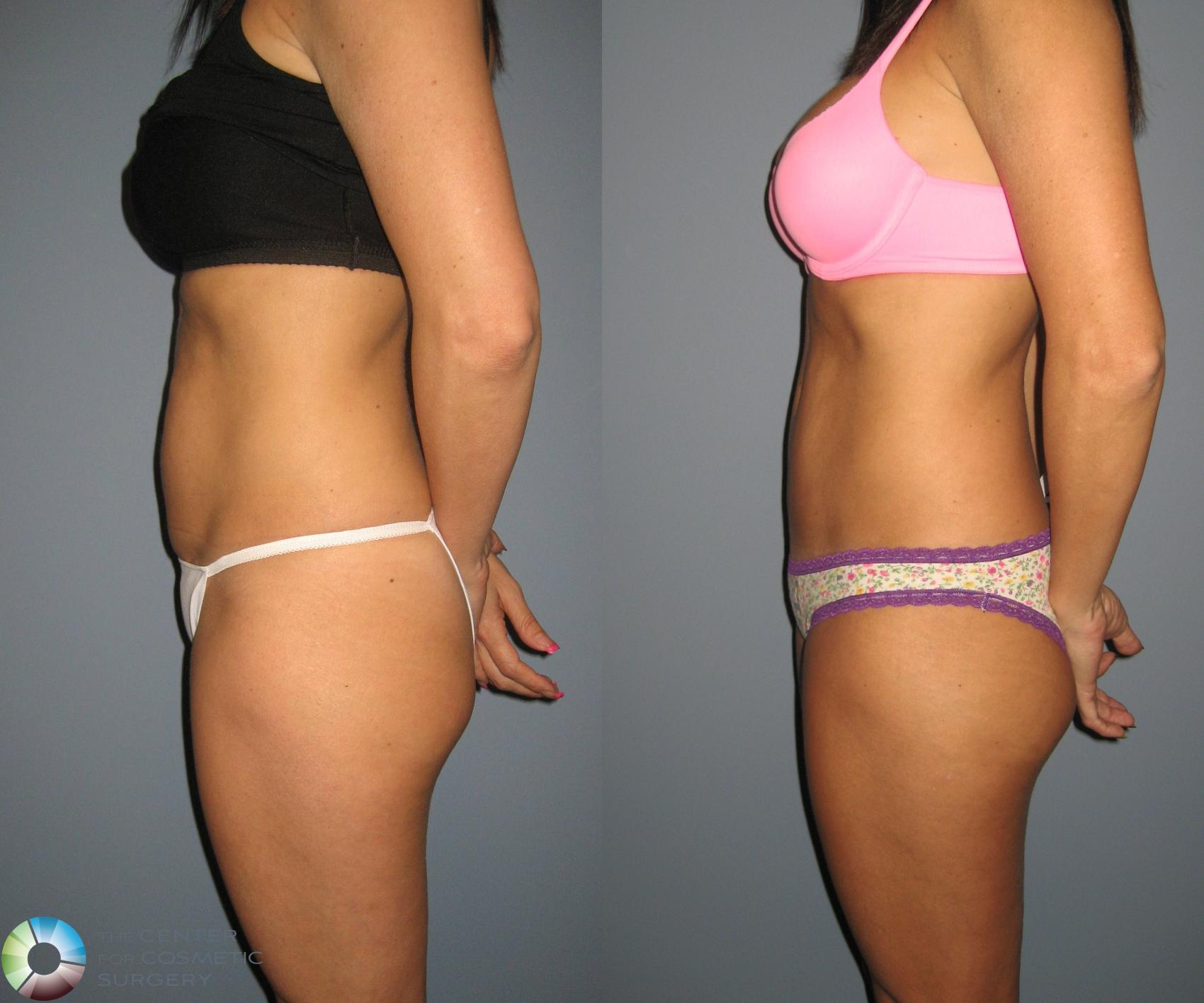 Before & After Tummy Tuck Case 447 View #3 in Denver and Colorado Springs, CO