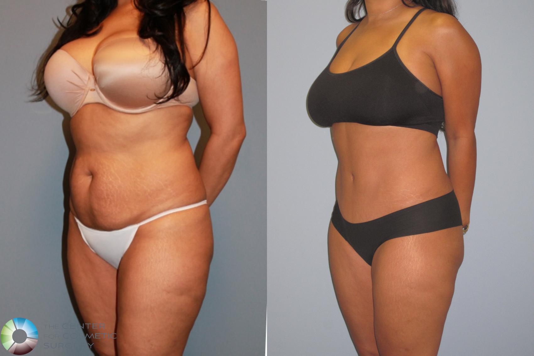 Before & After Tummy Tuck Case 487 View #2 View in Golden, CO