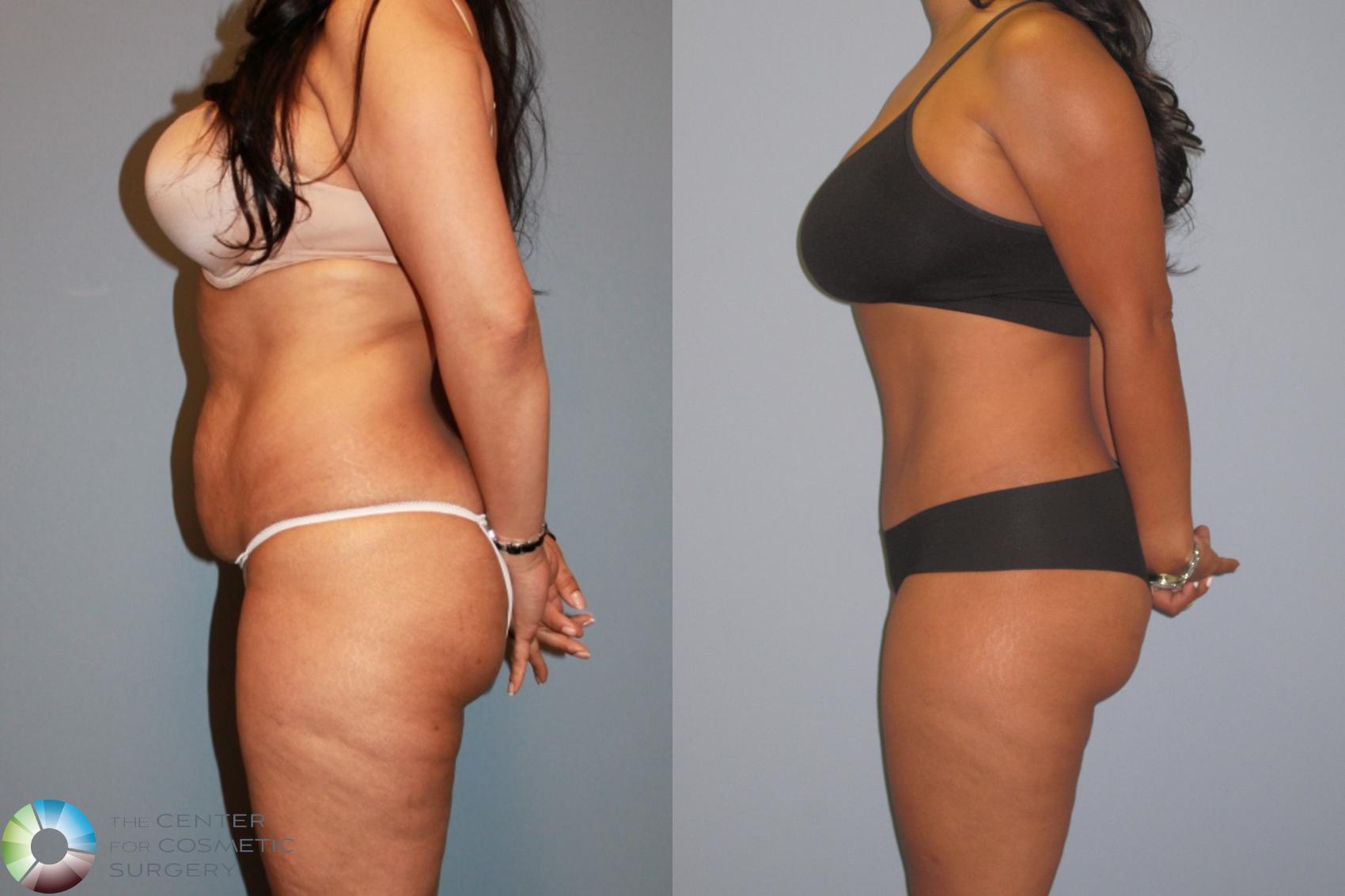 Before & After Tummy Tuck Case 487 View #3 in Denver and Colorado Springs, CO