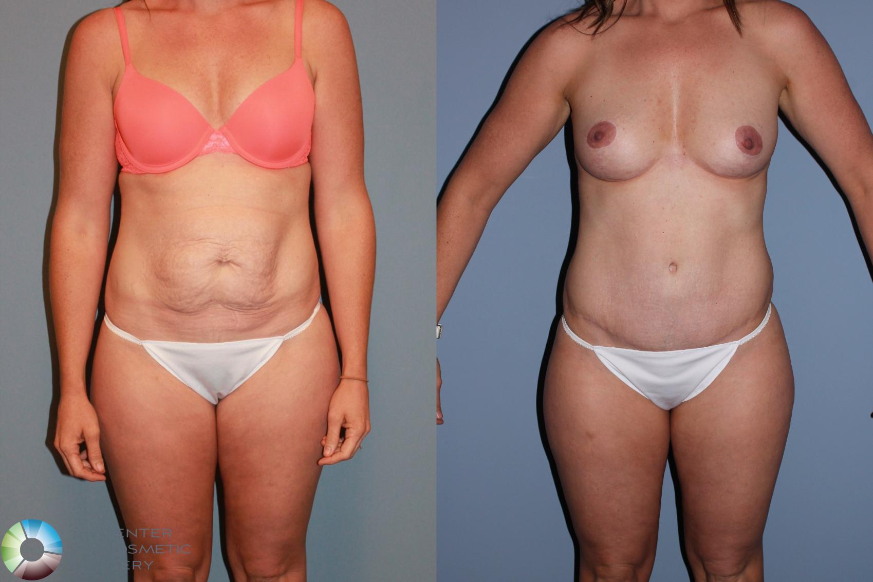 Before & After Liposuction Case 489 View #1 in Denver and Colorado Springs, CO