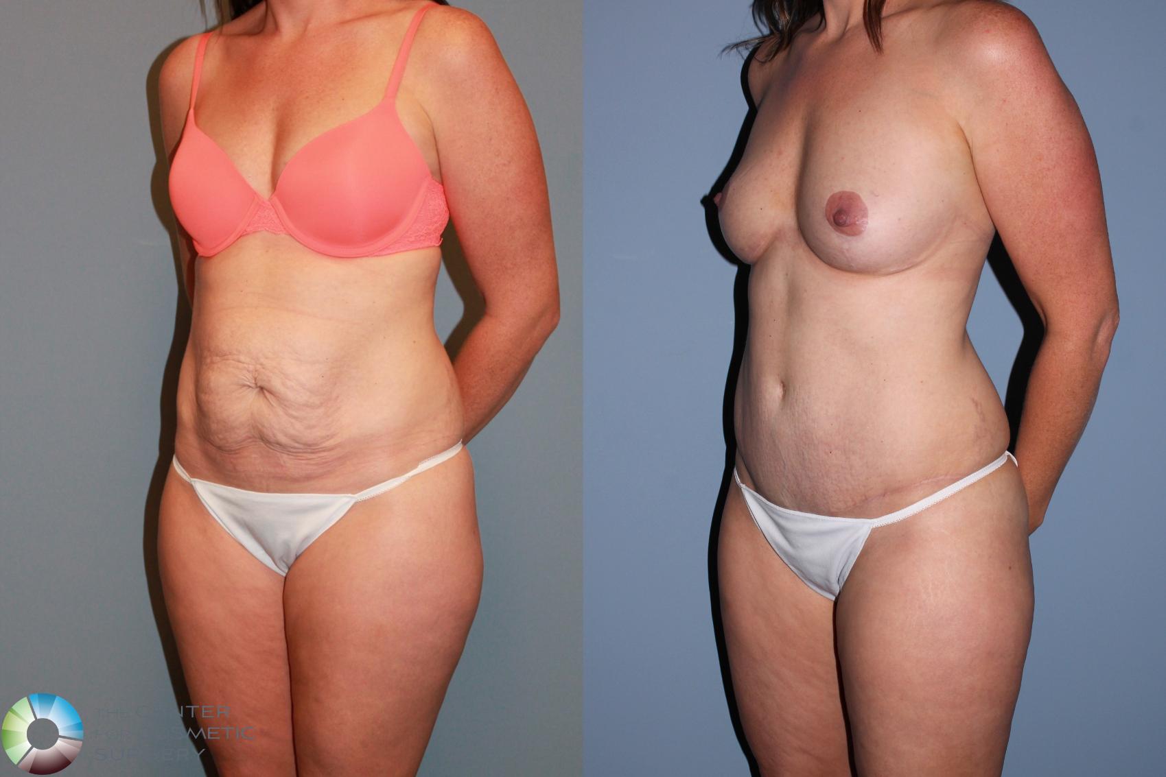 Before & After Tummy Tuck Case 489 View #2 in Denver and Colorado Springs, CO
