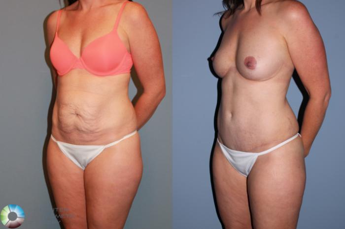 Before & After Tummy Tuck Case 489 View #2 View in Golden, CO
