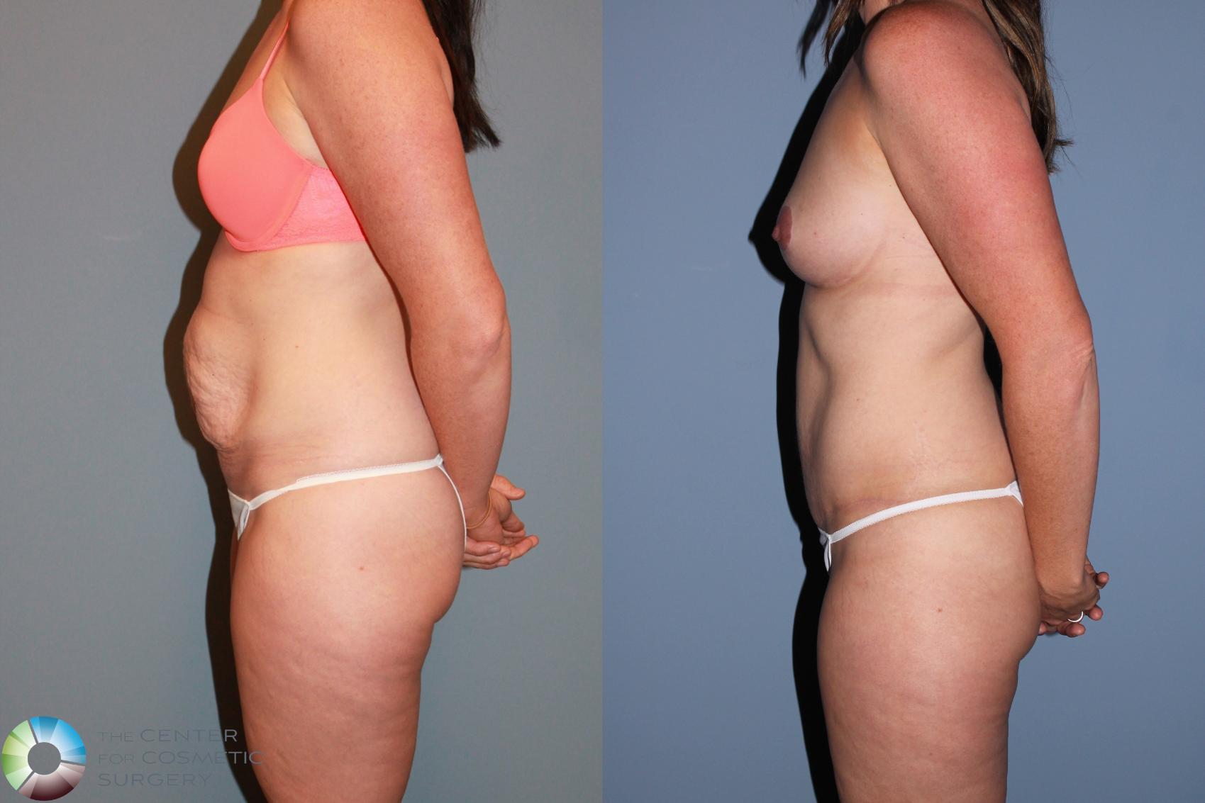 Before & After Tummy Tuck Case 489 View #3 in Denver and Colorado Springs, CO