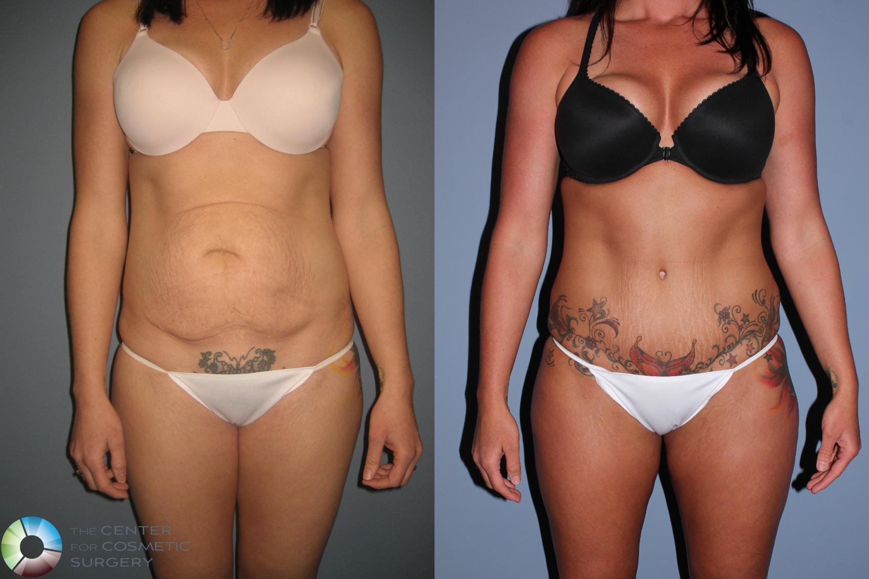 california cost of liposuction vs tummy tuck