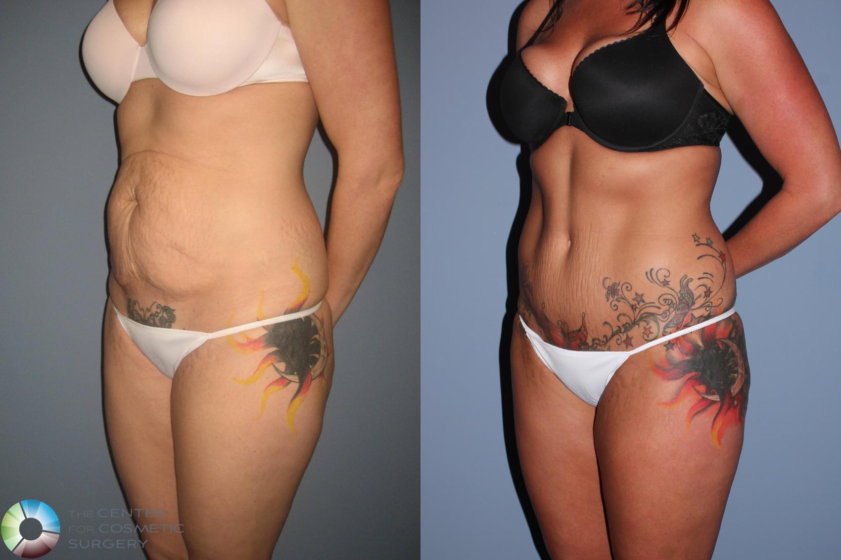 Before & After Tummy Tuck Case 490 View #2 View in Denver & Golden, CO